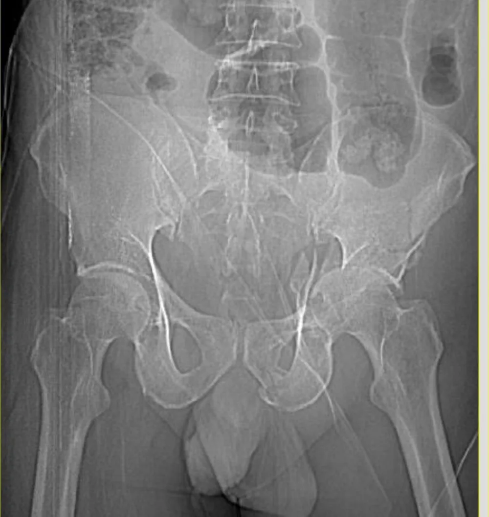 Post-operative radiograph following acetabular fracture fixation